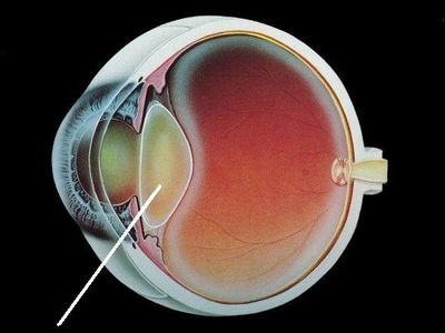Cataract-grphc.jpg 580×435 pixels