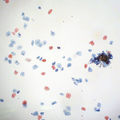 Pap Smear - Normal (or Negative) on Flickr - Photo Sharing!