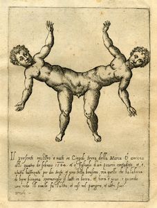 Flickr Photo Download: Male twins conjoined at the pelvis
